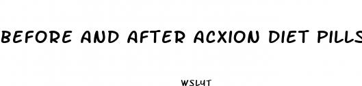before and after acxion diet pills
