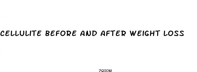 cellulite before and after weight loss