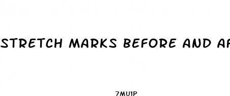 stretch marks before and after weight loss