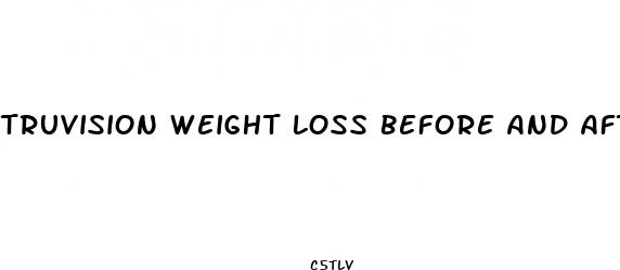 truvision weight loss before and after