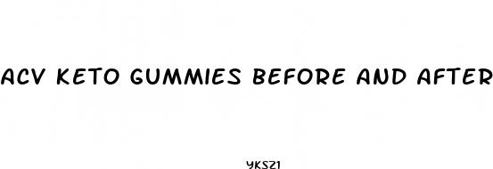 acv keto gummies before and after