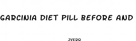 garcinia diet pill before and after