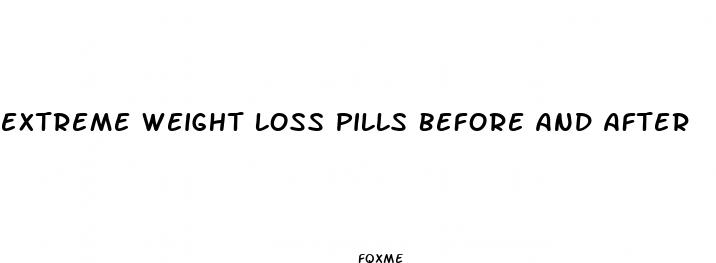 extreme weight loss pills before and after